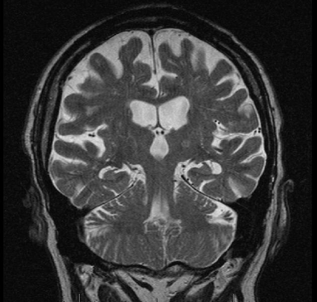 Epilepsy surgery in the elderly A B C Figure 2. A) Is an axial T2 image showing an area of encephalomalacia over the left frontal area.