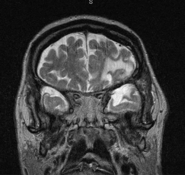 C) Shows atrophy of the left hippocampus, along with more generalized brain atrophy.
