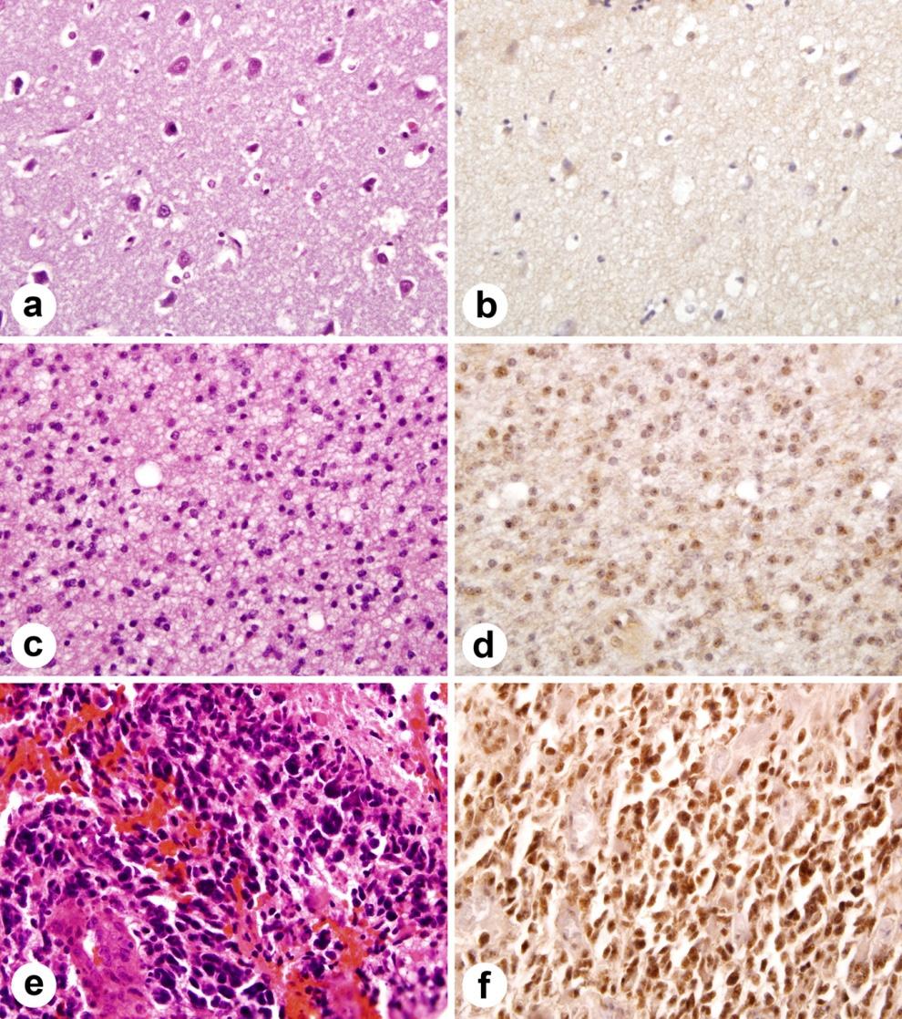 3 Figure 1. Immunohistochemical staining of Id4 protein in tissue microarray. Id4 expression correlates with astrocytoma grade. (a) normal brain tissue (H&E).