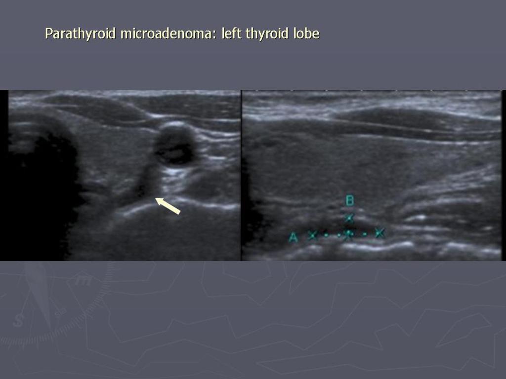 Fig. 9: Parathyroid microadenoma.
