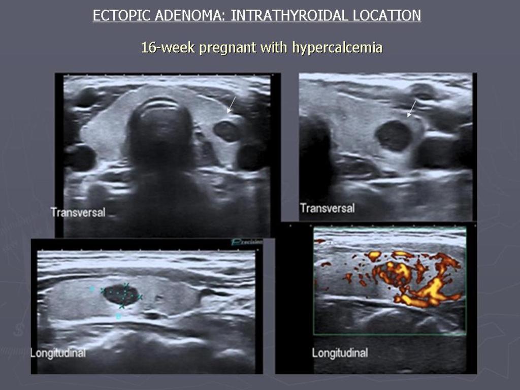 Fig. 13: INTRATHYROIDAL ADENOMA Ultrasound shows a very vascularized and