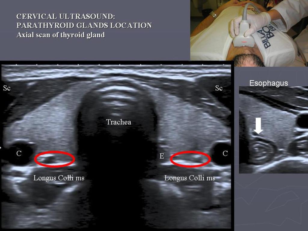 adenomas. Its sensitivity is slightly higher than ultrasound in parathyroid hyperplasia. (Fig.21). The main advantage over ultrasound is the detection of ectopic glands in mediastinum.