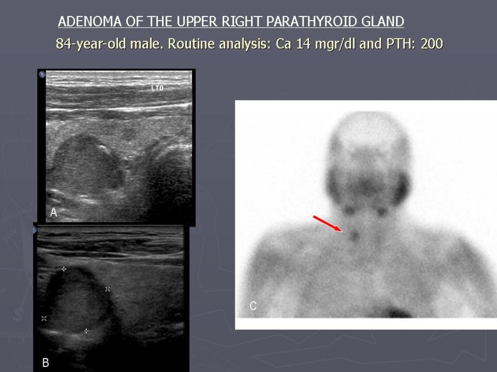 Fig. 5: ADENOMA OF THE UPPER RIGHT PARATHYROID GLAND 84-year-old male.