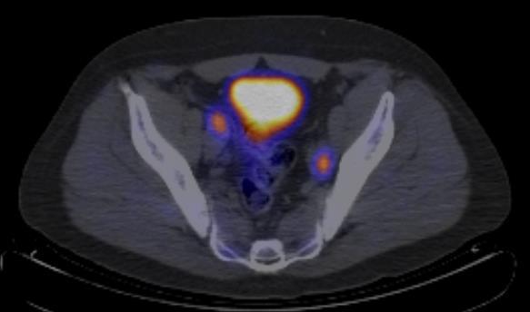 MRI spine negative Choline PET Several bilateral choline avid pelvic LN