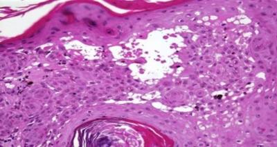 Squamous eddies may be confused with horn pearls of squamous cell carcinoma, but can be differentiated from them by their