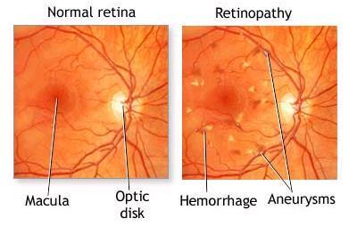 Fig. 2: showing normal Fundus & DR fundus photos [3] 4. Advanced diabetic eye diseases: It is the end result of uncontrolled proliferative diabetic retinopathy.