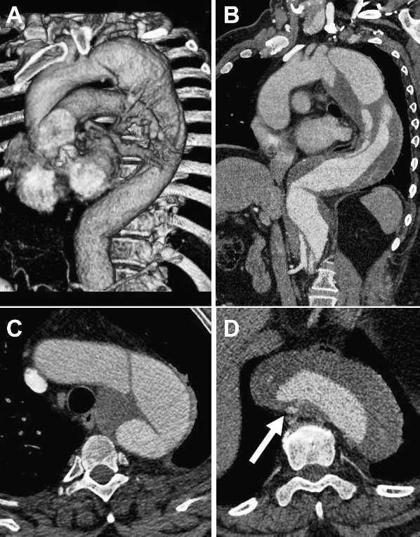 J ENDOVASC THER CANDY-PLUG TECHNIQUE 485 2013;20:484 489 Kölbel et al. distally because most aortic dissections extend distally across the visceral aortic segment and often into the iliac arteries.