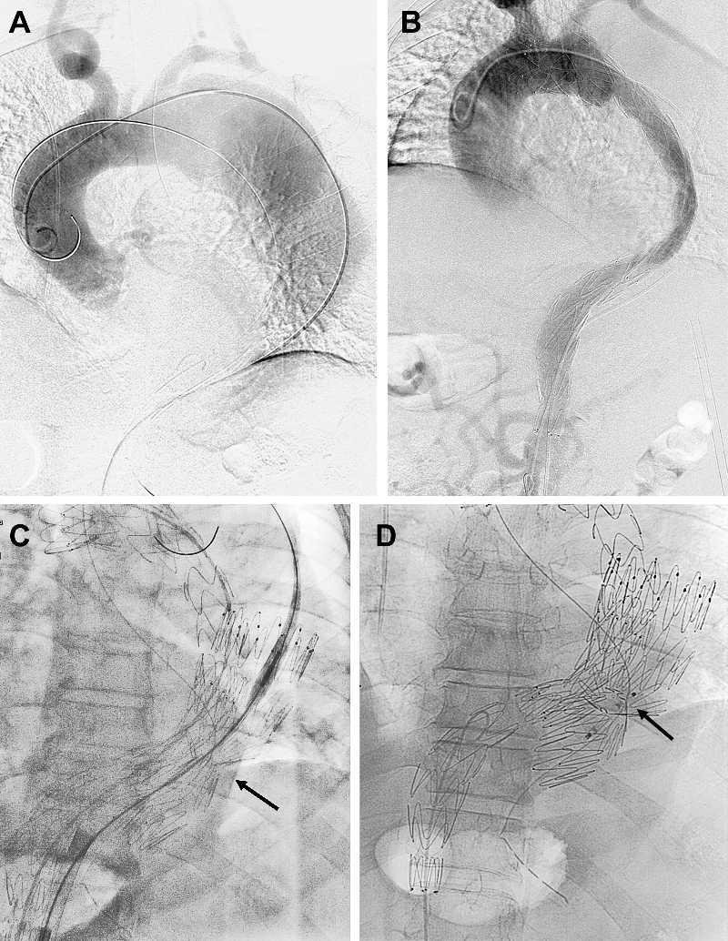 J ENDOVASC THER CANDY-PLUG TECHNIQUE 487 2013;20:484 489 Kölbel et al. Figure 3 Intraoperative digital subtraction angiography (A) before implantation of the low-profile stentgraft in the true lumen.
