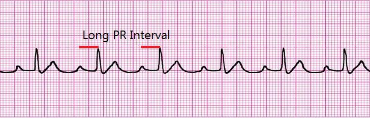 SINUS TACHYCARDIA Sinus tachycardia is a sinus rhythm with a rate greater than 100 per minute in an adult. Note that the p waves are still present.