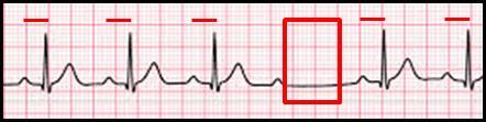 A Mobitz Type II heart block is characterized by an intermittent dropped QRS that is not in a Mobitz Type I pattern.