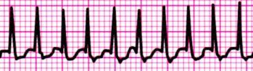 SUPRAVENTRICULAR TACHYCARDIA (SVT) Supraventricular tachycardia (SVT) is an extremely fast atrial rhythm with narrow QRS complexes when the impulse originates above the bundle branches (above the