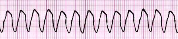 PULSELESS ELECTRICAL ACTIVITY Can be virtually any organized ECG rhythm in a patient who is unresponsive and lacks a palpable pulse. Thus, one cannot learn a PEA rhythm.