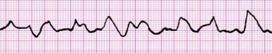 VENTRICULAR TACHYCARDIA (VT) Ventricular tachycardia (VT) is characterized by bizarre widened QRS complexes, no P waves and a heart rate that usually exceeds 100 beats per minute.