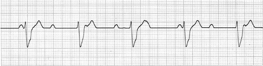 11. 3 RD DEGREE HEART BLOCK No serious signs or symptoms observation There are serious signs or symptoms What are the serious signs and symptoms?