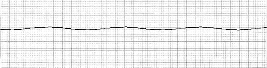 4. ASYSTOLE start CPR IV access Endotracheal intubation Confirmation in more than one lead Consider transcutaneous pacing Epinephrine (1mg iv push, repeat every 3-5 minutes) Consider the cause
