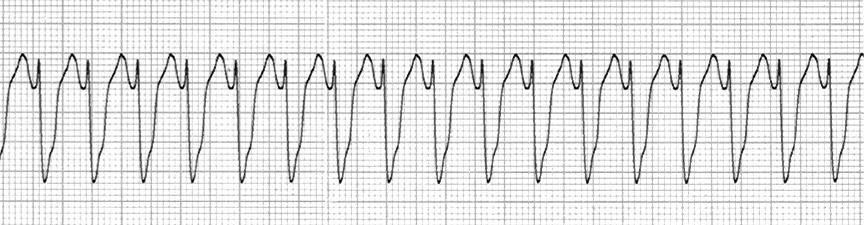 6. VENTRICULAR TACHYCARDIA (With Pulse) / Pulseless VT Stable - Oxygenation - IV access - MONA - Amiodarone - DC cardioversion Unstable signs and symptoms?