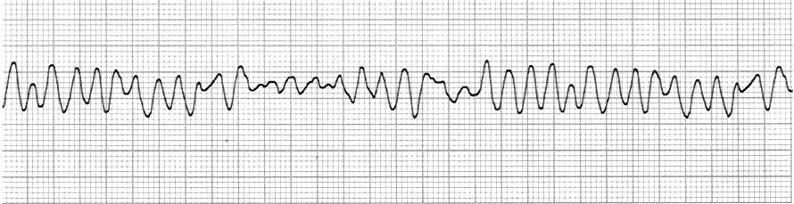 7. VF (VENTRICULAR FIBRILLATION) SHOCK as soon as available (ONE TIME) CPR Shock Rhythm Epinephrine (1mg IV) & CPR SHOCK Intubate if