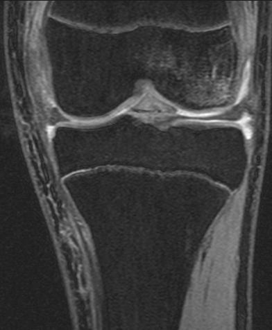 Children Tibial Eminence Fractures 90% - subchondral bone contusions Lateral femoral condyle 80% Lateral tibial plateau 80% Medial femoral condyle 60% Medial