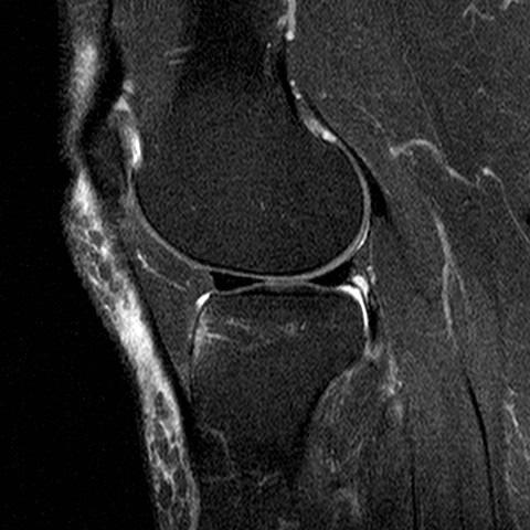 Dashboard Injury Force applied to anterior proximal tibia while knee in flexed position Disruption of PCL and