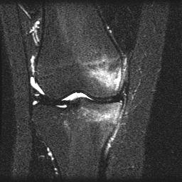 Hyperextension Anterior aspect of tibial plateau strikes anterior femoral condyle Kissing contusion +/- ACL, PCL or meniscal injury