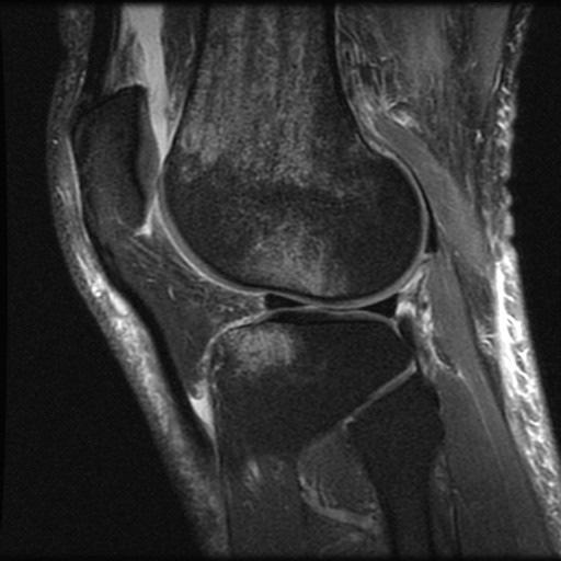 Hyperextension Anterior aspect of tibial plateau strikes anterior femoral condyle Kissing contusion +/- ACL, PCL or meniscal injury