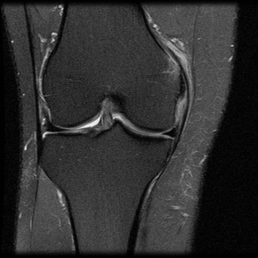 Clip Injury +/- MCL sprain or disruption Most common proximal ligament near femoral attachment