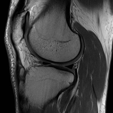 Osgood-Schlatter Disease Traction apophysitis Strong forces from quadriceps mechanism Insertion of patellar