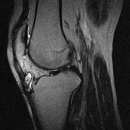 Osgood-Schlatter Disease Common causes of anterior knee pain 12-15 y/o boys 8-12 y/o girls Repeated jumping/squatting Local
