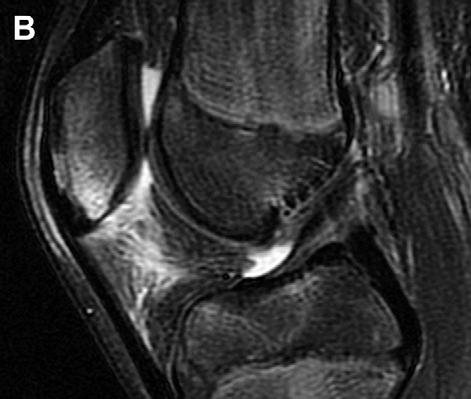 Patellar Sleeve Avulsion Adolescent boy jumpers near skeletal maturity Sharp fragments are visible and