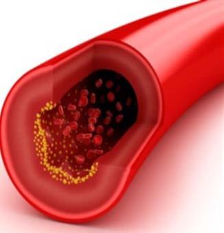 CHARACTERIZATION OF THE HEALTH EFFECT High Blood Cholesterol: 3 major classes of lipoproteins that make up serum total cholesterol (TC) include: Low density lipoprotein (LDL) bad High density