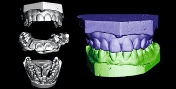 superimposed on to CBCT
