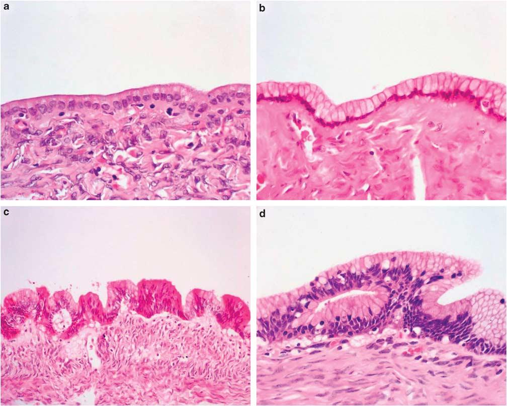 Y Zen et al 1083 Figure 2 Histopathology of hepatic mucinous cystic neoplasms.