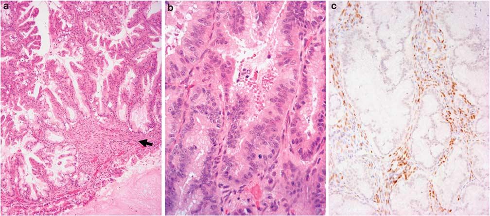 1084 Y Zen et al Figure 3 A carcinoma in situ case of hepatic mucinous cystic neoplasm. (a) There is papillary proliferation of atypical epithelium with fibrovascular cores.