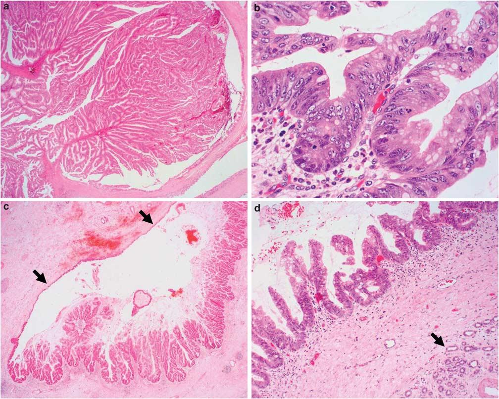 Y Zen et al 1085 Figure 4 Histopathology of biliary intraductal papillary neoplasms. (a) There is a papillary tumour in the cystic space.