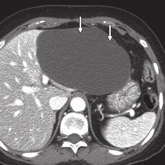 CT of Hepatic Cystic Neoplasms and Cysts Fig. 3 64-year-old woman with solitary bile duct cyst.