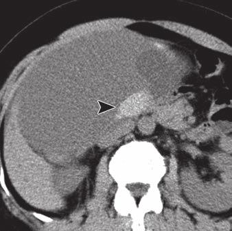 A and B, Transverse unenhanced CT images show ovoid cystic mass with different densities in each locule, constituting mosaic pattern, and two high-density lesions (arrow, A; arrowhead, B).