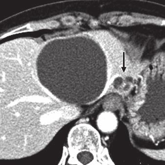 CT of Hepatic Cystic Neoplasms and Cysts Fig. 8 66-year-old woman with solitary bile duct cyst. A and B, Transverse contrast-enhanced CT images show round cystic lesion.