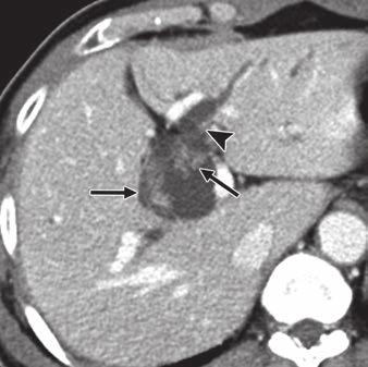 CT, they may be helpful in establishing an accurate diagnosis, thereby reducing the chance of incomplete surgery, such as fenestration, for mucin-producing cystic neoplasms.