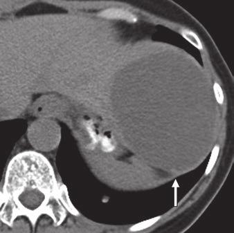 9 63-year-old woman with cyst-forming intraductal papillary neoplasm of bile duct.