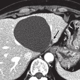 B, Coronal contrast-enhanced reformatted CT image shows both upstream and downstream bile duct dilatation (arrowhead) and mural nodules (arrows). Fig.