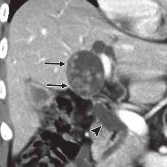 B, Transverse contrast-enhanced CT image shows high-density nodular lesion without enhancement (arrow). It was interpreted as intracystic debris.