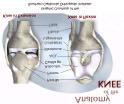 Derangement Anatomy of the Knee Please differentiate an internal derangement from an external knee injury.