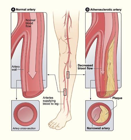 What Is Peripheral Artery Disease? P.A.D. occurs when arteries in the legs and feet become narrow or clogged with fatty deposits called plaque. Blood flow may slowly decrease over time.