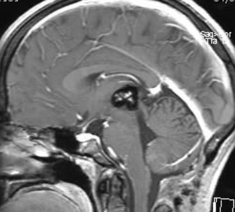 glioma in tectal plate near IIIrd ventricle after neurosurgery, severe