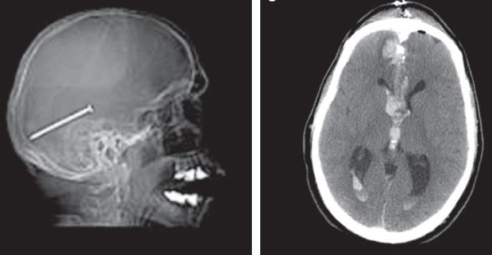 Brain injury causing secondary narcolepsy in 48 yr-old