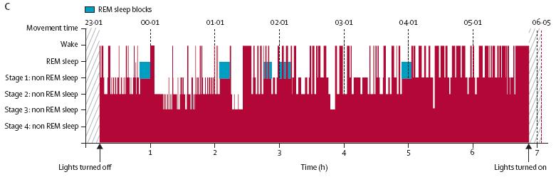 sleepiness during day SOREM in 4/4 naps on MSLT fragmented