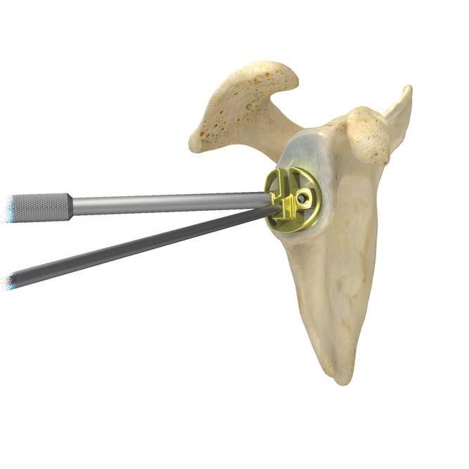 Figure 25 Glenoid There are two baseplate options (Mini and Standard) available, each with specific instrumention.
