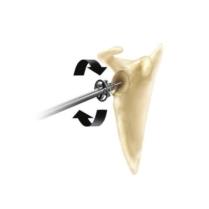 Comprehensive Reverse Shoulder System Figure 26 Figure 26a Note: Obtaining a pre-operative CT scan will help identify bone erosion which may affect glenoid tilt and/ or version.