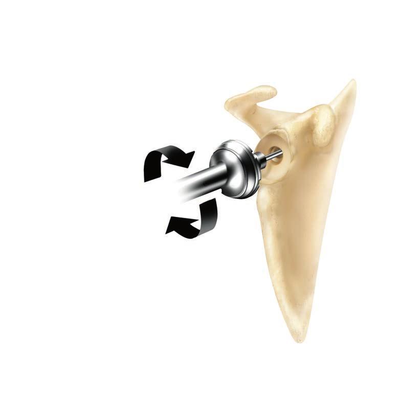 Gold Figure 27 Figure 28 It is critical to remove any excess bone and soft tissue from the glenoid face (typically inferior) that may prevent complete impaction of the glenosphere/taper assembly into