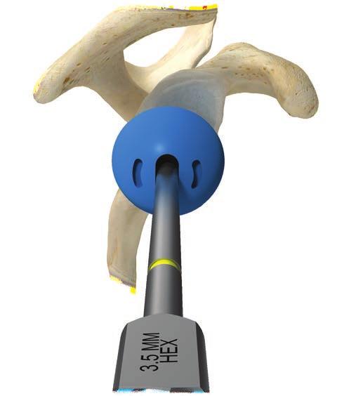 Comprehensive Reverse Shoulder System Figure 41 Figure 42 After desired positioning of glenosphere trial is achieved, tighten the taper adaptor trial in the head trial with the appropriate hex driver